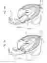Fig. 03 - Transapical method of supplanting an implanted prosthetic heart valve