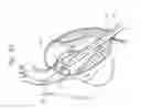 Fig. 04 - Transapical method of supplanting an implanted prosthetic heart valve