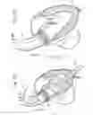 Fig. 06 - Transapical method of supplanting an implanted prosthetic heart valve