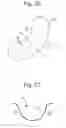 Fig. 09 - Subtalar joint implant