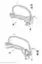 Fig. 22 - Devices and methods facilitating sleeve gastrectomy procedures