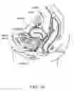 Fig. 02 - Device positionable in the uterine cavity