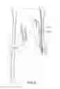 Fig. 03 - Nerve cuff electrode for neuromodulation in large human nerve trunks