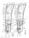 Fig. 11 - Safety cutter apparatus and system