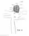 Fig. 06 - Shape-memory polymer foam device for treating aneurysms