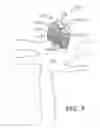 Fig. 08 - Shape-memory polymer foam device for treating aneurysms