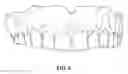 Fig. 04 - Method of making a denture with nature bite and wear properties and denture