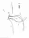 Fig. 04 - Adjustable suture button construct
