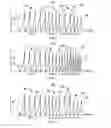 Fig. 04 - Adjusting the apodization pattern for diffractive IOLs