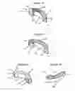 Fig. 02 - Transforaminal intersomatic cage for an intervertebral fusion graft and an instrument for implanting the cage