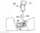 Fig. 01 - Apparatus and method for forming an opening in patient's tissue