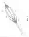Fig. 02 - Perfusion balloon with external valve