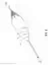 Fig. 08 - Perfusion balloon with external valve