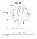 Fig. 13 - Electrical stimulation for preservation and restoration of diaphragm function
