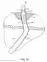 Fig. 07 - Urethral catheters and methods for facilitated introduction into the urinary tract