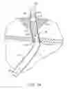 Fig. 08 - Urethral catheters and methods for facilitated introduction into the urinary tract