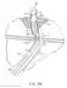Fig. 09 - Urethral catheters and methods for facilitated introduction into the urinary tract