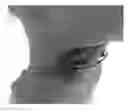 Fig. 01 - Transdermal electrical stimulation at the neck to induce neuromodulation
