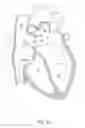 Fig. 22 - Systems and methods for treating cardiac arrhythmias