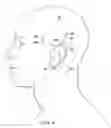Fig. 16 - Surgical method for implantable head mounted neurostimulation system for head pain