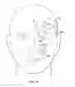 Fig. 34 - Surgical method for implantable head mounted neurostimulation system for head pain