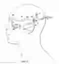 Fig. 37 - Surgical method for implantable head mounted neurostimulation system for head pain