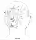 Fig. 41 - Surgical method for implantable head mounted neurostimulation system for head pain