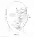 Fig. 43 - Surgical method for implantable head mounted neurostimulation system for head pain