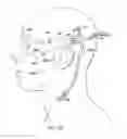 Fig. 45 - Surgical method for implantable head mounted neurostimulation system for head pain