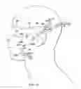 Fig. 47 - Surgical method for implantable head mounted neurostimulation system for head pain