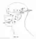 Fig. 48 - Surgical method for implantable head mounted neurostimulation system for head pain