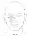 Fig. 52 - Surgical method for implantable head mounted neurostimulation system for head pain