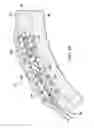 Fig. 53 - Surgical method for implantable head mounted neurostimulation system for head pain