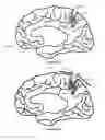 Fig. 13 - IMPROVED METHODS AND APPARATUS FOR CORTICAL STIMULATION MAPPING DURING SURGICAL PROCEDURES
