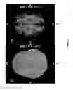 Fig. 22 - IMPROVED METHODS AND APPARATUS FOR CORTICAL STIMULATION MAPPING DURING SURGICAL PROCEDURES