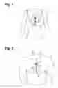 Fig. 02 - Extended wear electrocardiography and physiological sensor monitor