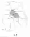 Fig. 06 - Anatomical concentric spheres THA