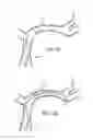 Fig. 17 - Galvanically assisted attachment of medical devices to thrombus