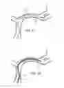 Fig. 18 - Galvanically assisted attachment of medical devices to thrombus