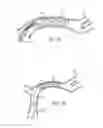Fig. 19 - Galvanically assisted attachment of medical devices to thrombus