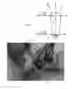 Fig. 06 - PERIOSTEUM ELEVATION TIP AND METHOD OF USE