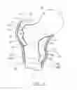 Fig. 07 - Patient-specific fracture fixation instrumentation and method