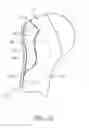 Fig. 08 - Patient-specific fracture fixation instrumentation and method