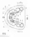 Fig. 03 - Removable orthodontic correction device