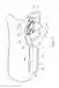 Fig. 04 - Removable orthodontic correction device