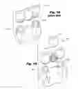 Fig. 07 - Dental Implant