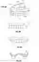 Fig. 03 - ONE VISIT DENTURE