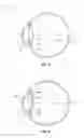 Fig. 02 - Intraocular lens and methods for providing accommodative vision