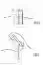 Fig. 05 - Device for treating a body tissue, and associated treatment kit