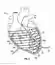 Fig. 03 - CARDIAC ASSISTANCE DEVICE